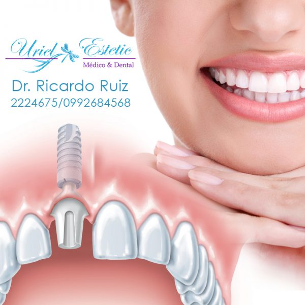 Nosotros Especialistas en implantes dentales en Quito, Ecuador